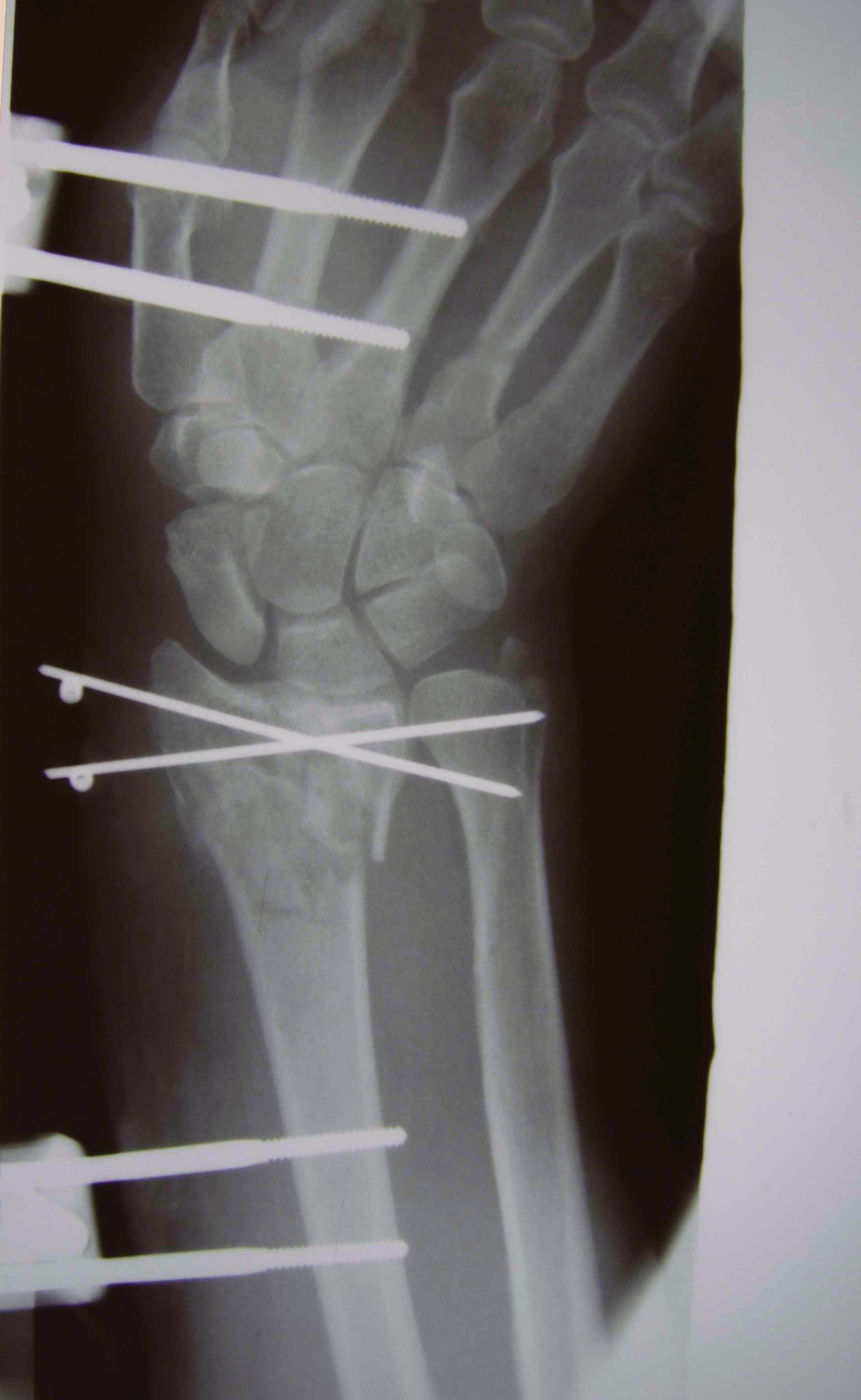 Distal Radius External Fixation